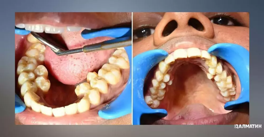 Жительницу Индии признали женщиной с самым большим количеством зубов в мире.
