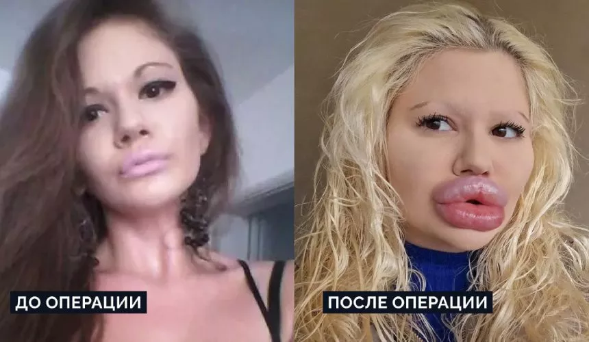 Женщина «с самыми большими губами в мире» сделала за день шесть пластических операций на лице